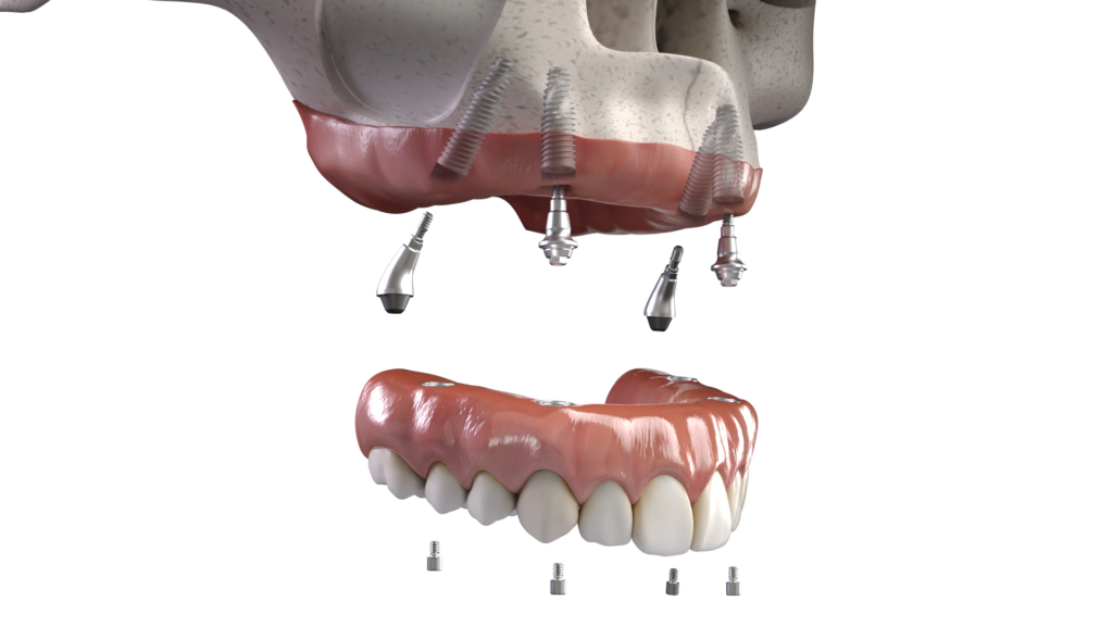 all-on-x dentures in tulsa
