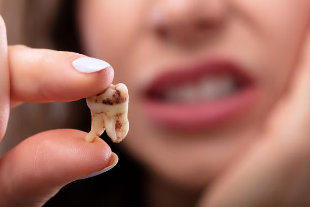 5 Key Signs You Need A Tooth Pulled Now